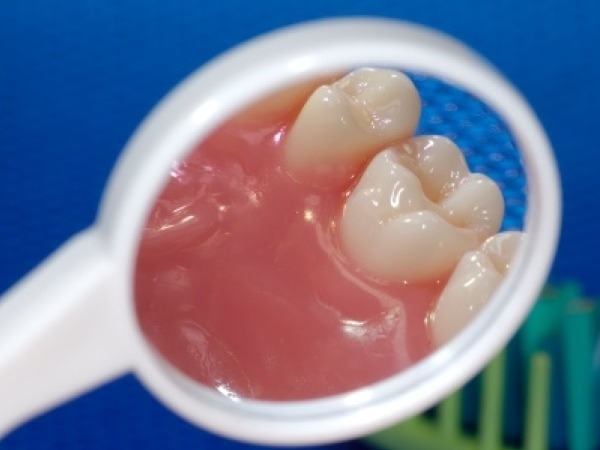 牙龈炎的治疗方法及其偏方,牙龈炎自愈的秘诀小妙招