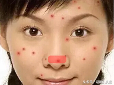 35岁女性脸上反复长痘痘怎么调理,下巴长满痘痘是什么原因怎么调理