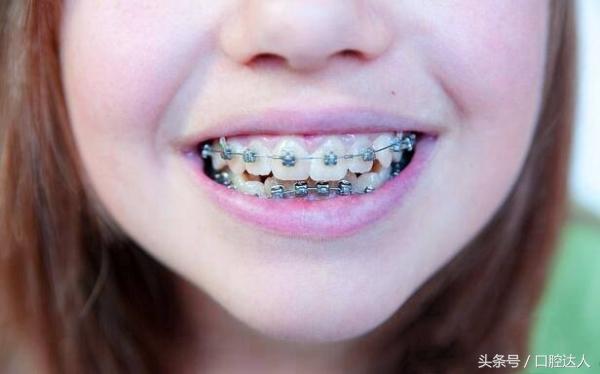 女生戴牙套吃东西日常,带着牙套该怎么吃饭