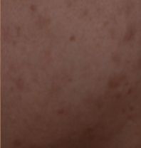 皮肤科修复痘坑大全,痘印痘坑修复皮肤科医生