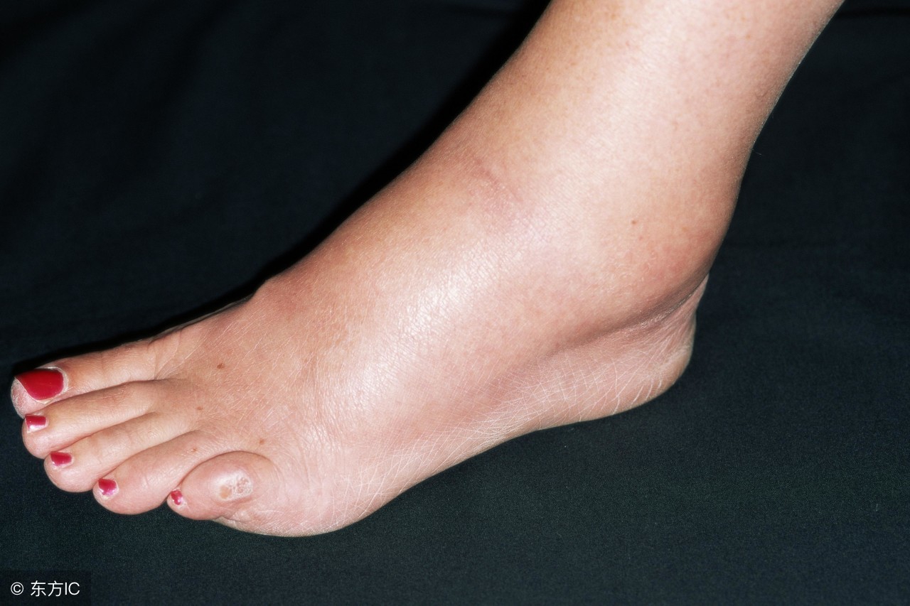 慢性心衰后期只能喝水拉肚子,心衰引起的腹胀多久可以消除