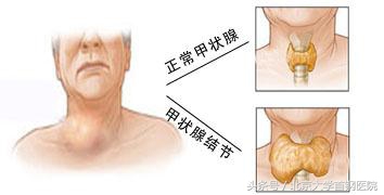 颈部多普勒超声检查是什么,颈部超声检查能检查什么