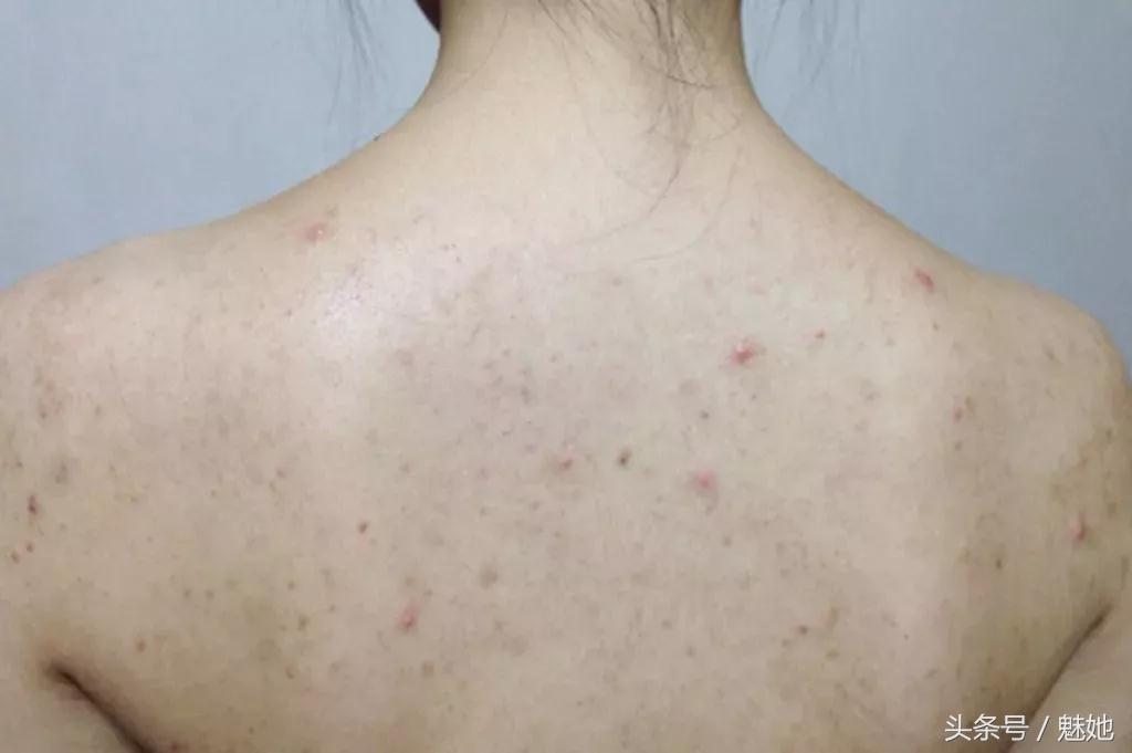 鸡皮肤背部痘印怎么祛除,去后背痘去鸡皮的方法