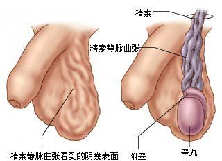 精索静脉曲张2.5,精索静脉曲张