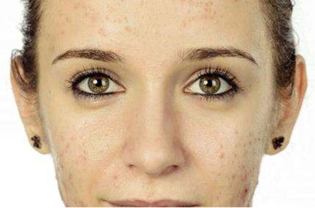 想要祛痘印用什么精华比较好,想要祛除痘印需要做什么医美