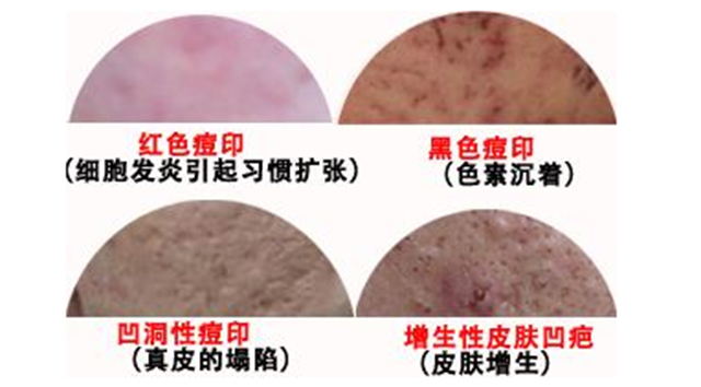 想要祛痘印用什么精华比较好,想要祛除痘印需要做什么医美