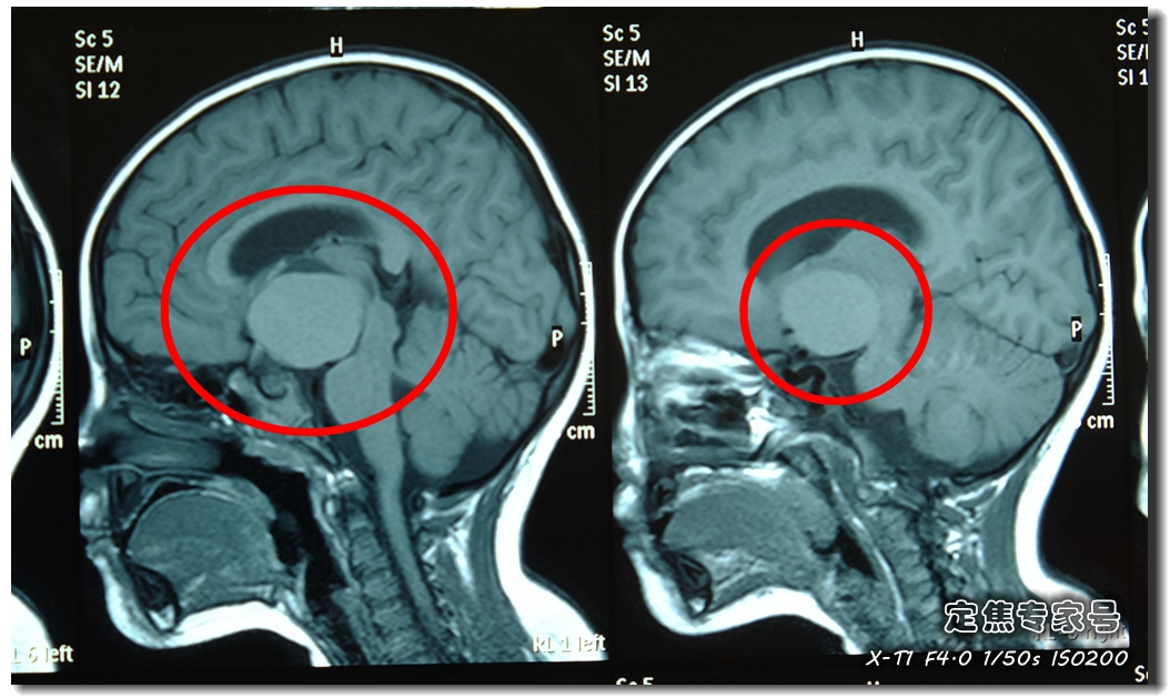 它伪装成发烧感冒侵入女童颅脑，最终却让妈妈连夜千里奔袭