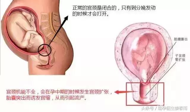 宫颈松弛导致流产的症状,流产会引起宫颈口太松吗