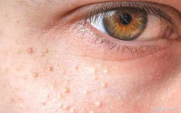 护肤品用了长脂肪粒是怎么回事,眼周护肤品不吸收起脂肪粒怎么办