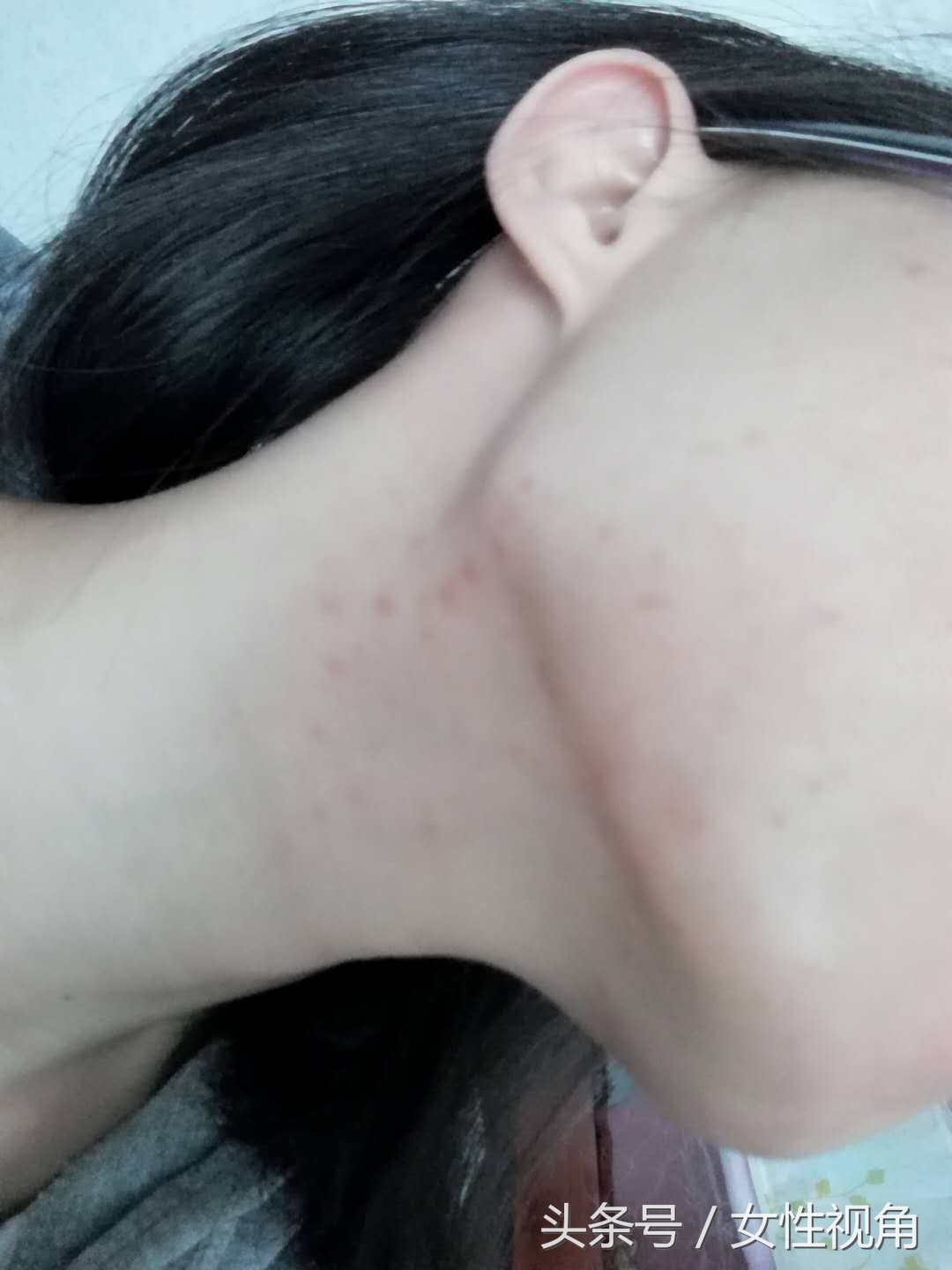 十年战痘的真实经历,十年抗痘血泪史真实经历