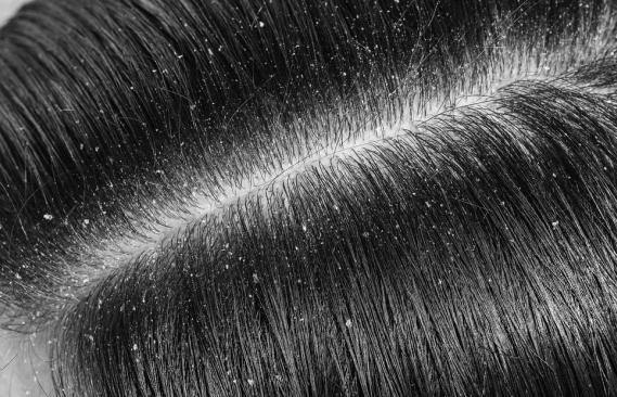 春季头上痒有头皮屑怎么办,头痒长头皮屑用什么方法治疗