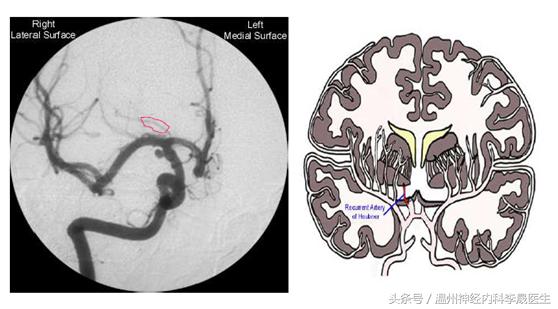 张景明教授讲脑中风后遗症,李医生讲中风视频全集