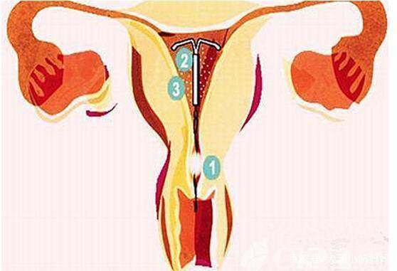 生完二胎该戴环还是结扎,生完二胎的妈妈如何永葆青春