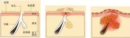 头发出油掉发后背长痘,前胸后背下巴长痘怎么回事