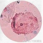 瀛曞缁嗚弻鎬ч槾閬撶値鐥囩姸,瀛曟湡鏌ュ嚭姊呮瘨鑰佸叕浼氫粙鎰忓悧