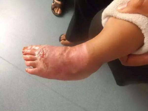 烧水烫伤紧急处理,烫伤烧伤的紧急处理ppt