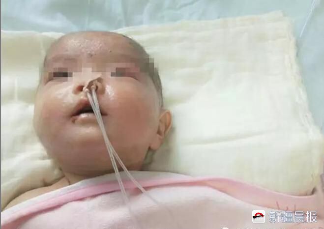 3岁水痘护理,三个月宝宝感染水痘会很严重吗