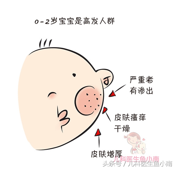 宝宝湿疹热疹区别,宝宝湿疹和热疹怎么观察
