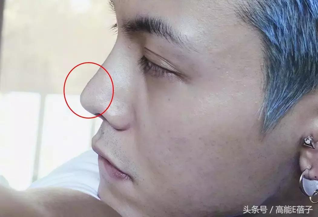 蔡徐坤、Angelababy都根治不掉的黑头，微商神器能去除？