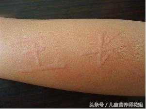 荨麻疹成因和根治方法,麻疹和荨麻疹有什么区别能治好吗