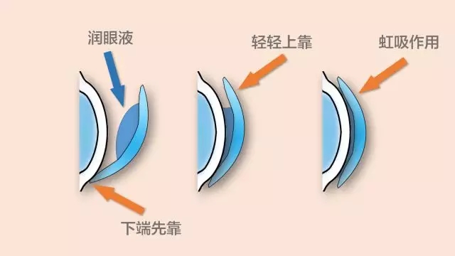 ok镜怎样戴减少气泡,ok镜带偏处理方法