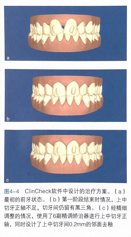 牙齿上的黑三角怎么才能清洗干净,去除牙齿黑三角的神器