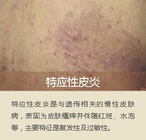 面部脂溢性皮炎辨别图片,面部脂溢性皮炎怎么治