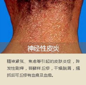 面部脂溢性皮炎辨别图片,面部脂溢性皮炎怎么治