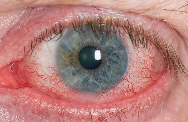 深海鱼油对干眼症有作用吗,鱼油对干眼症真的有效吗