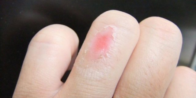 烫伤后水泡破了的护理和注意事项,烫伤水泡的护理措施