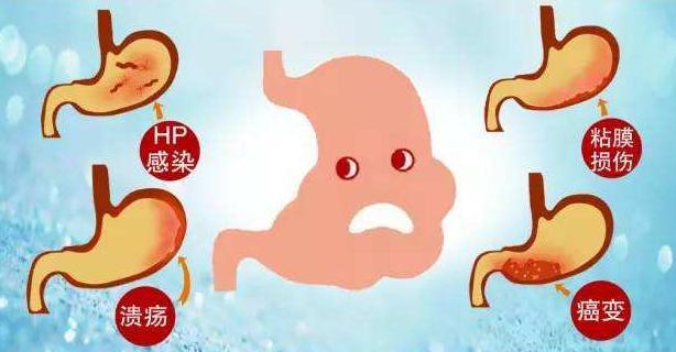 幽门螺旋杆菌最怕的四种食物,幽门螺杆菌吃什么食物能彻底根除