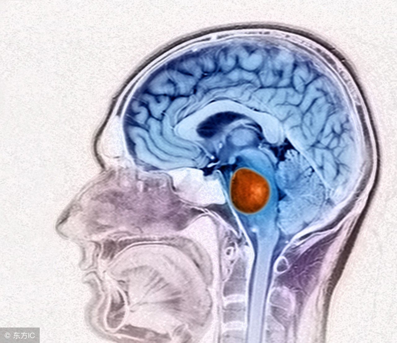 儿童脑瘤的七大征兆,儿童脑瘤的症状表现