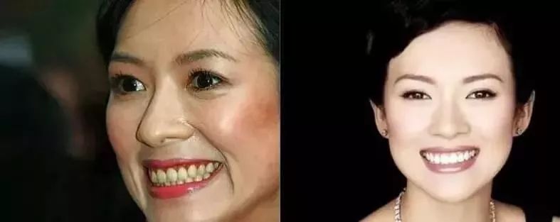 日本牙膏修复牙洞是真的吗,为什么日本人牙那么白