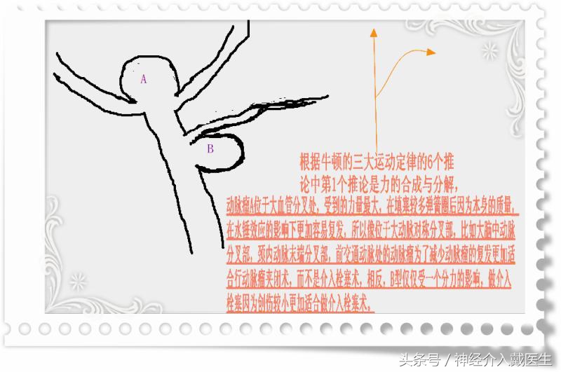 关于动脉瘤的治疗有几种方法,颅内动脉瘤的最新指南和共识