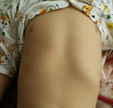 宝宝鸡胸能不能治好,孩子鸡胸是什么原因怎么办