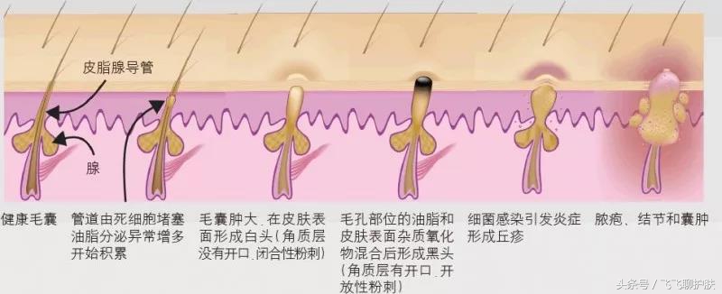 各种痘痘的类型及治疗方法,四种常见的痘痘类型应该如何区分