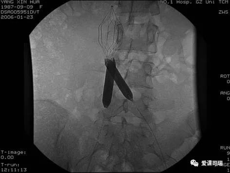 爱老师敲黑板,脚踝两侧变黑溃烂怎么回事