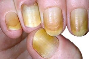 看指甲识健康,从指甲看疾病的图片说明