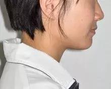 矫正牙齿可以变美吗,矫正牙齿后变美更自信