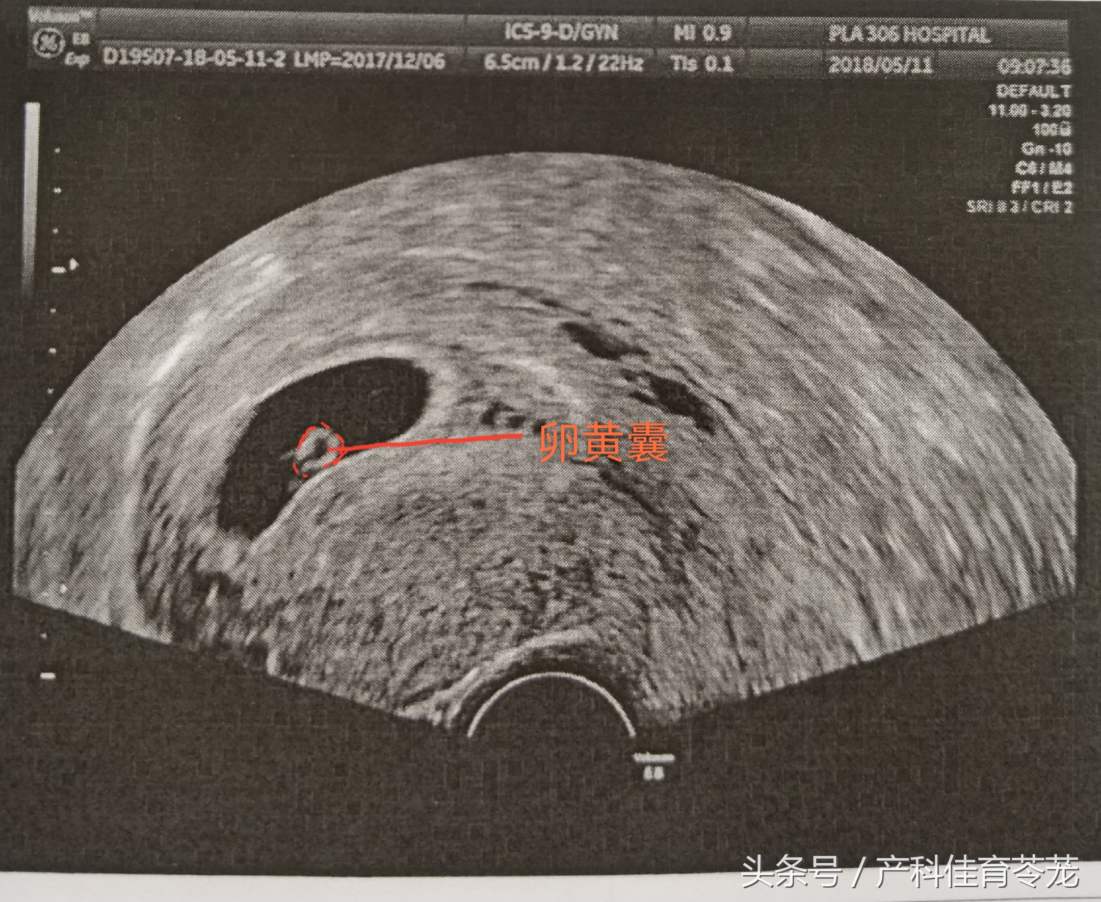 b超的3组数字代表什么,b超图片上的数字