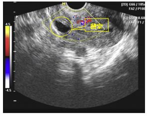 剖宫产引起的例假淋漓不尽怎么办,妇科剖腹产术后月经不干净