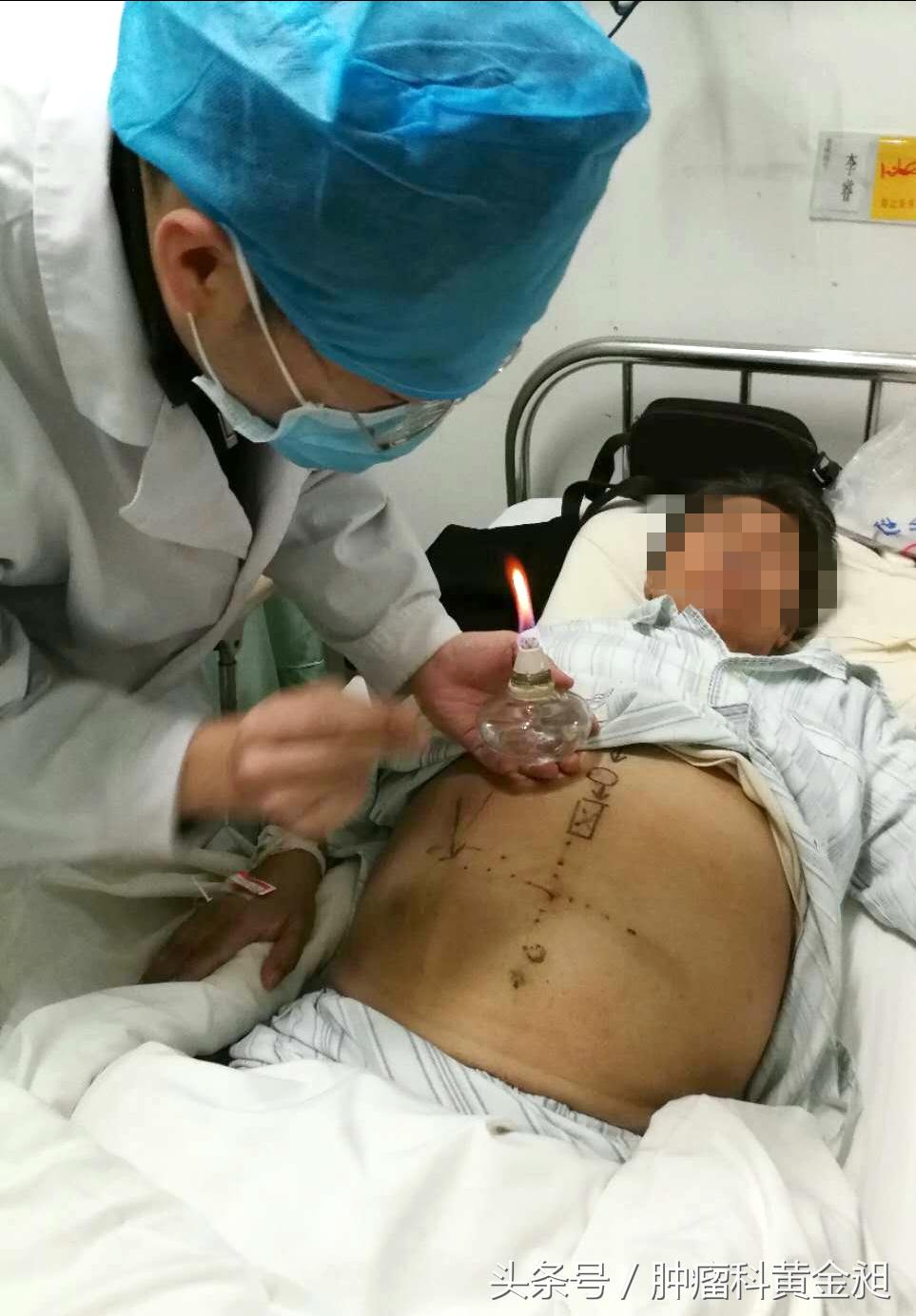 病案分享:中西医结合治疗老年卵巢癌晚期至肿瘤影像学消失1例