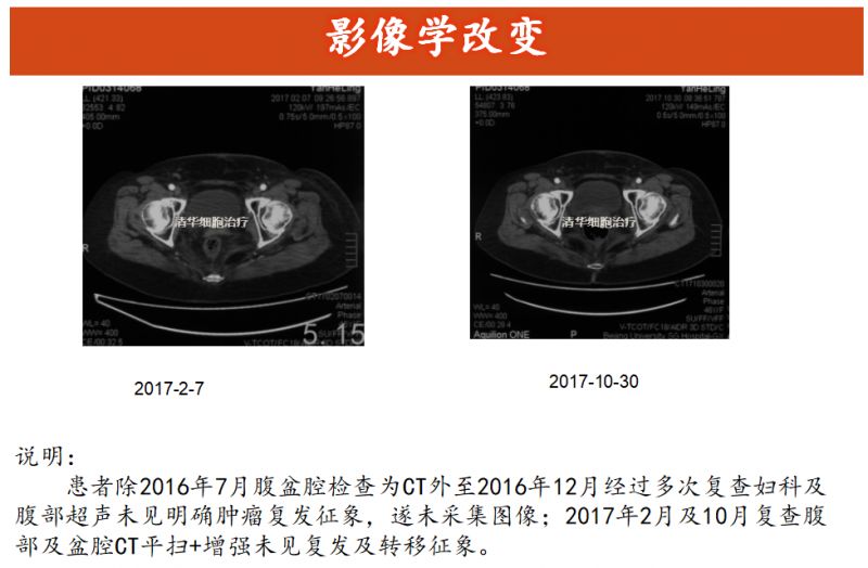 子宫内膜癌nccn指南解读,2020子宫内膜癌nccn指南