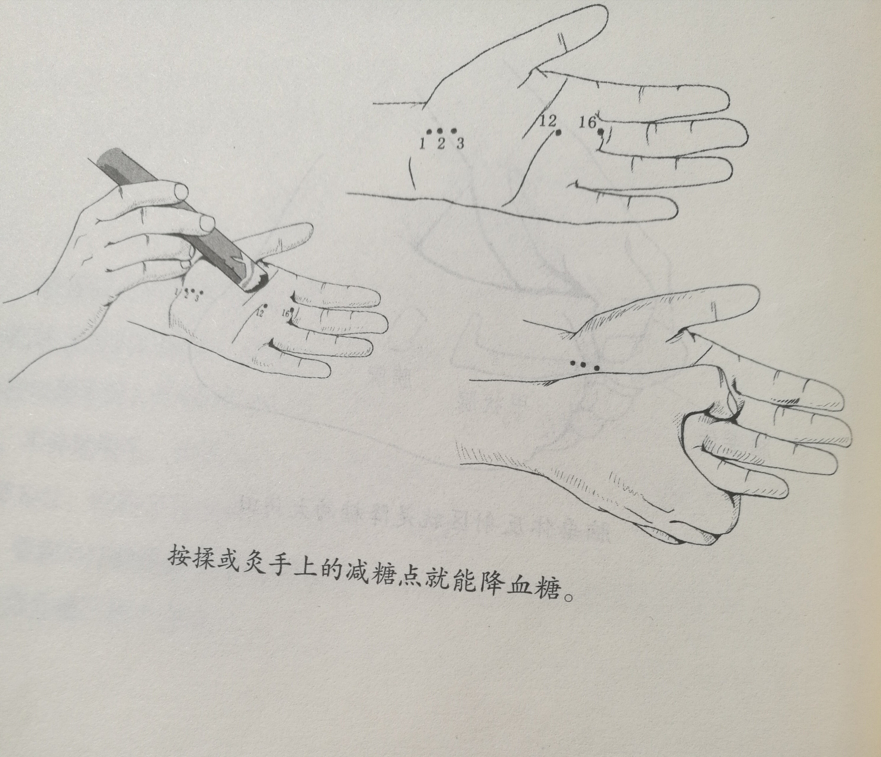 现在糖尿病最有可能治愈的方法,糖尿病不再打针吃药