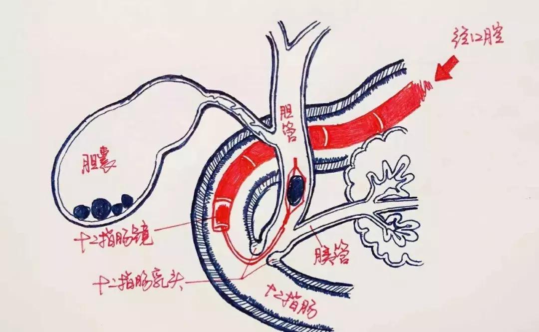 胆总管结石可治吗,1厘米的胆总管结石能不做手术吗