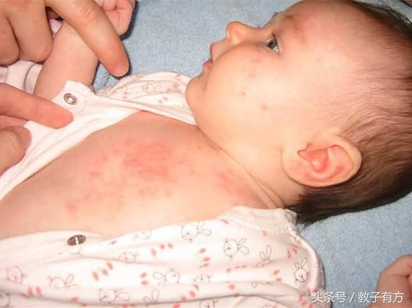 儿童痱子湿疹一招搞定,幼儿痱子和湿疹的症状及处理方式