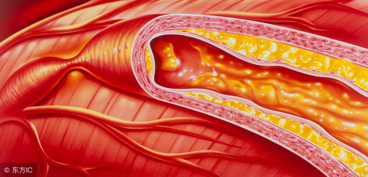什么是纯合子家族高胆固醇血症,高胆固醇血症患者首选什么药物