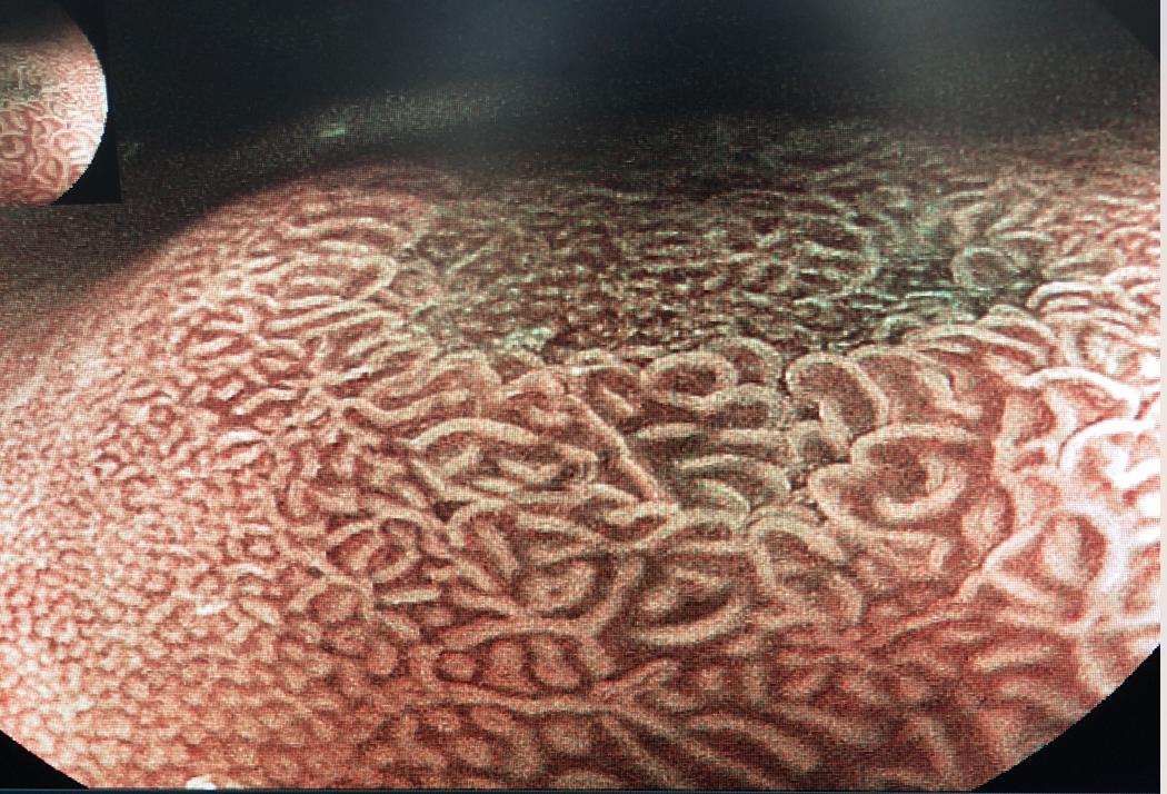 什么是慢性胃炎伴肠上皮化生？