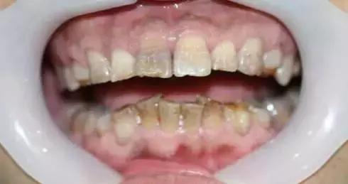 原来，上牙盖住下牙太多，也对牙齿有伤害！该怎么矫正？