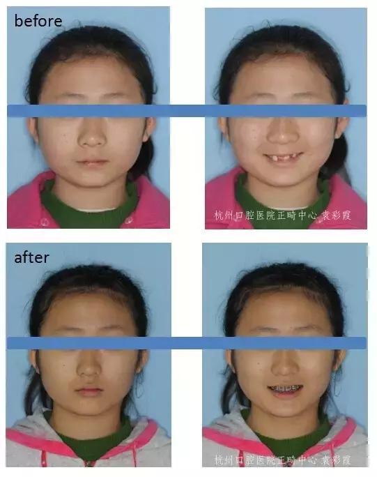 原来，上牙盖住下牙太多，也对牙齿有伤害！该怎么矫正？